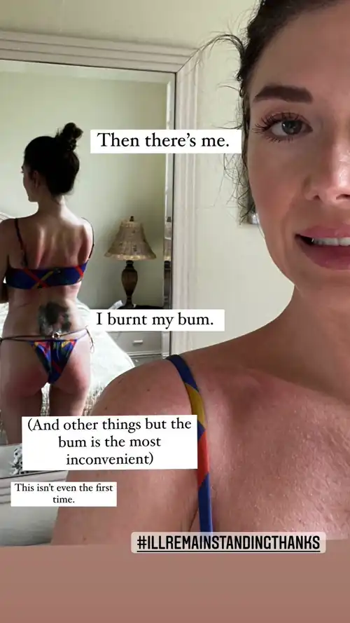 burnt bum